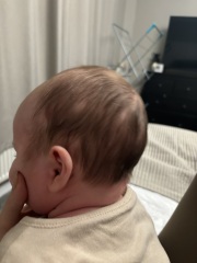 Baby bald patches