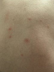 Is this Chicken Pox or more serious?