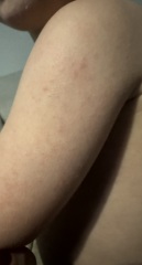 Dry bumpy toddler skin in winter? Help (pictures)