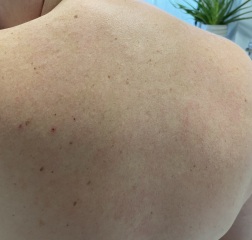 Rash on back