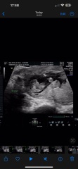 Gender Scan 15 weeks!! Please ease my mind!!