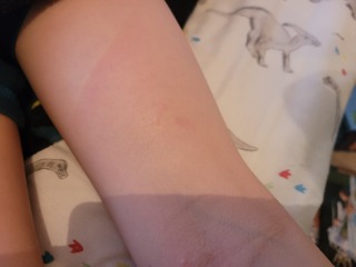 Any idea what this might be on DS' leg?