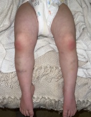 Are these normal toddler bruises on legs?