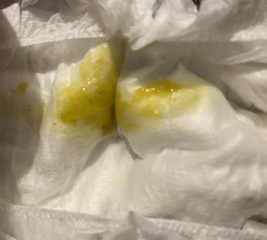 3 month old diarrhoea- Advice please