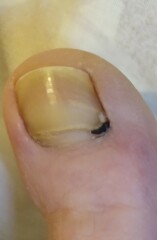 Should I see a GP with this toenail thing (pictures included)?