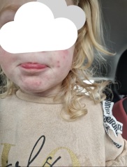 Chicken pox? Hand foot and mouth?