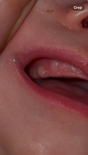 Teething lumps on gums?