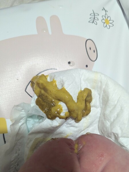 Anti reflux milk (warning nappy picture)