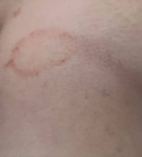 Caught ringworm from someone’s cat, should I post to Facebook
