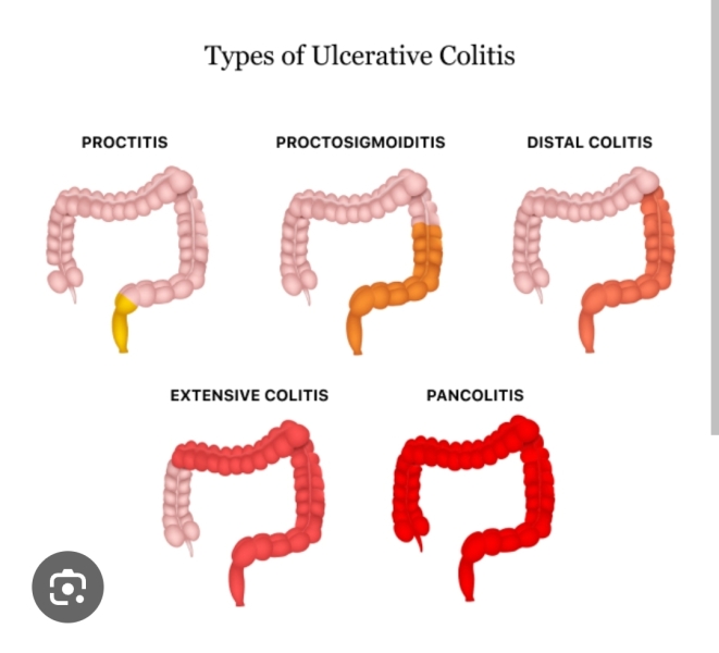 Ulcerative colitis anyone. ??????