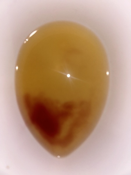 TMI picture - blood in urine so worried.