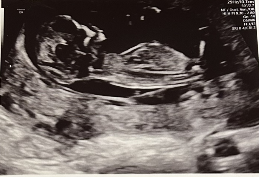 Gender guess nun theory 12 week scan