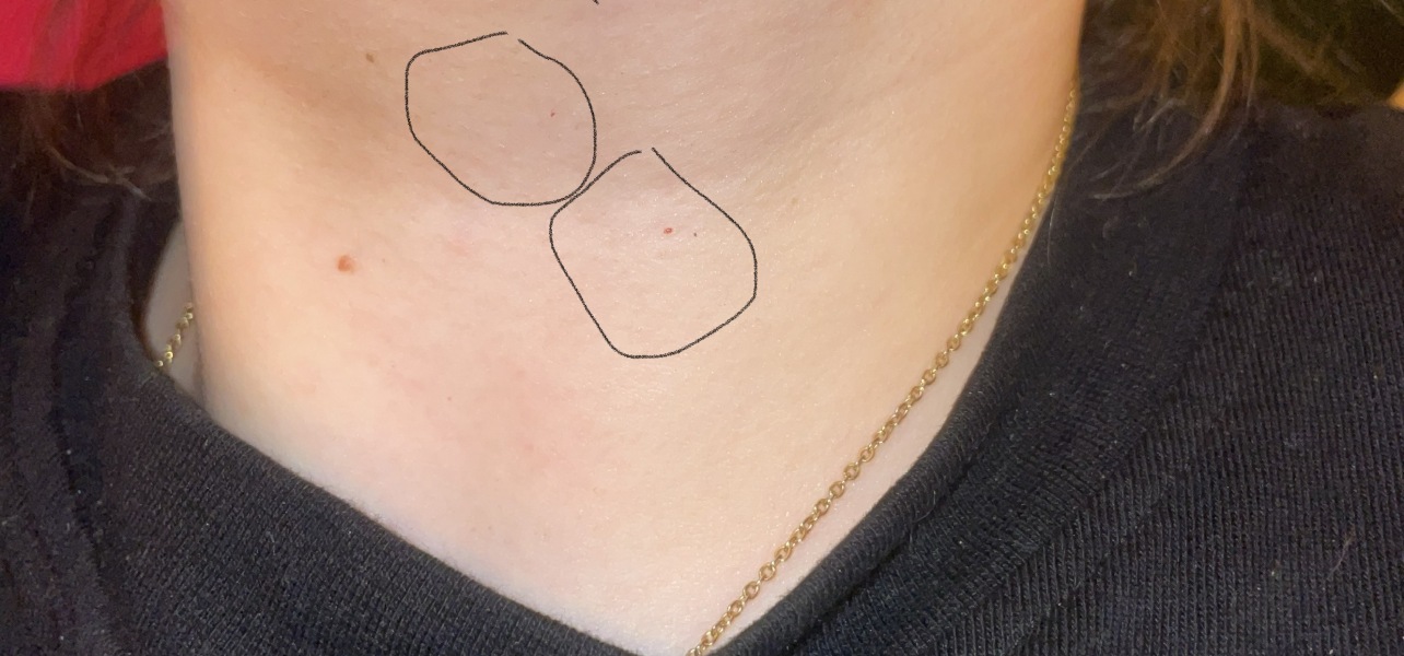 Is this petechiae?