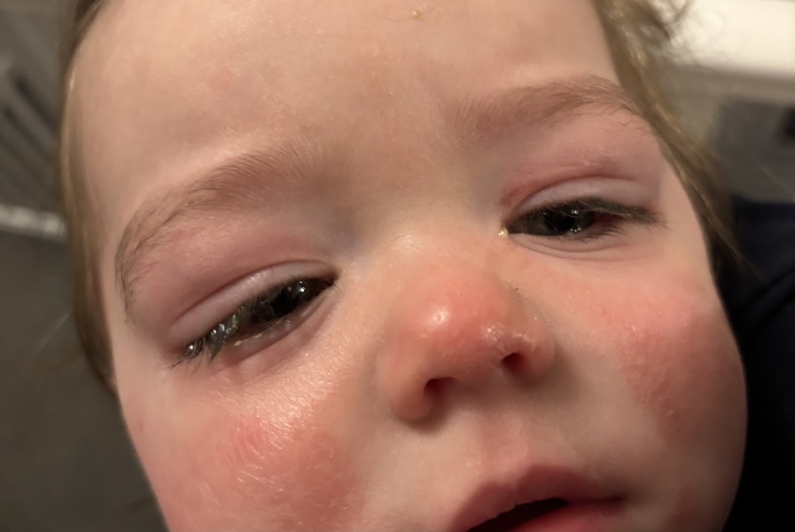 Conjunctivitis or cellulitis of eye?