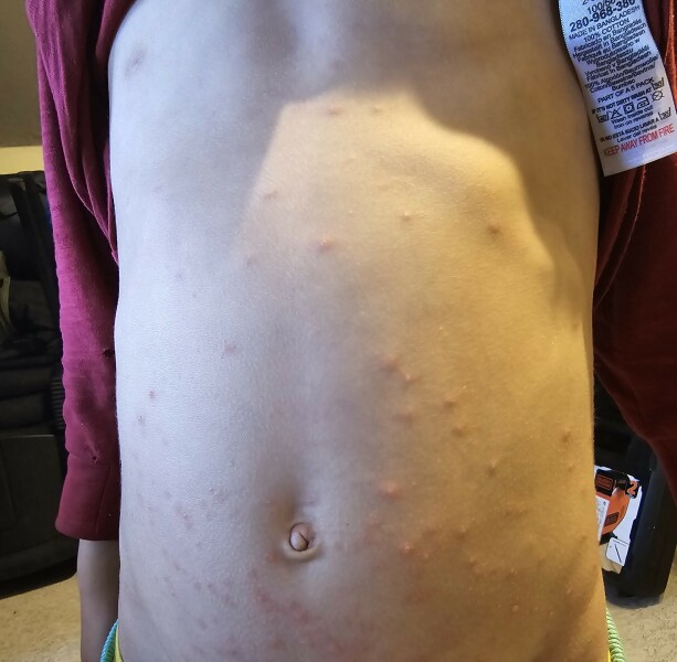 Is this chickenpox? Pic attached
