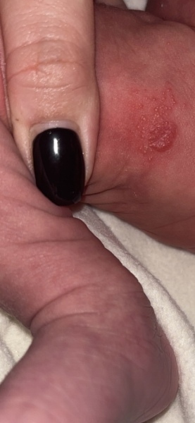 Baby rash
