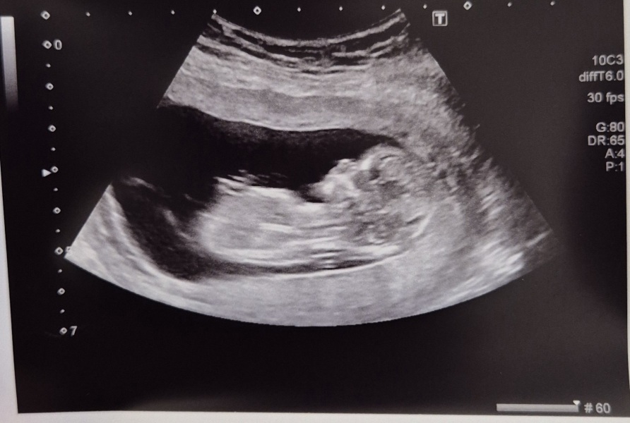 Due July 25 - Thread 2 - Approaching the 12 week scans!