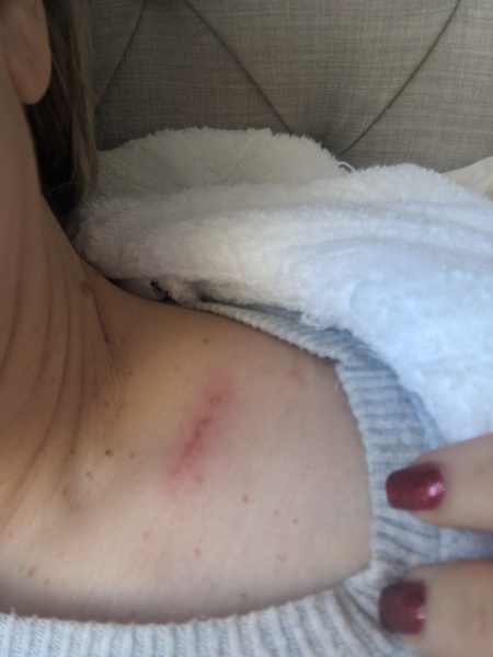 Shingles or Herpes?