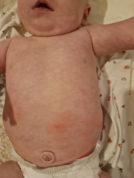 Chicken pox?