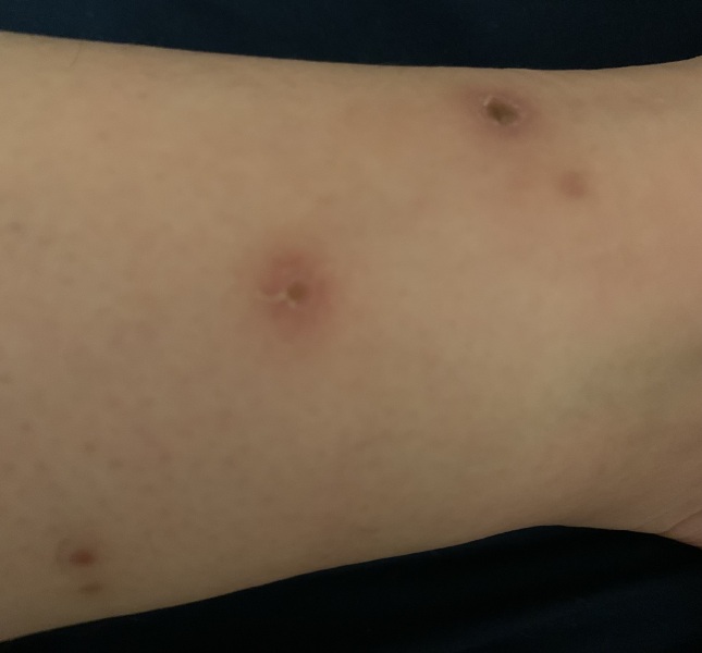 (Warning pic attached)Are they flea or bed bug bites ?