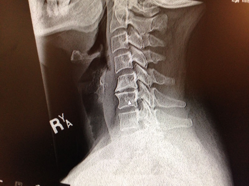 Any radiologists/doctors around who wouldn't mind taking a peek at my neck x ray?