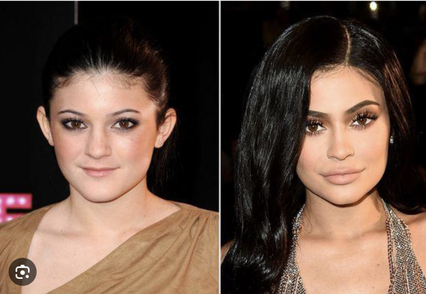 Why do people get massive amounts of lip filler?