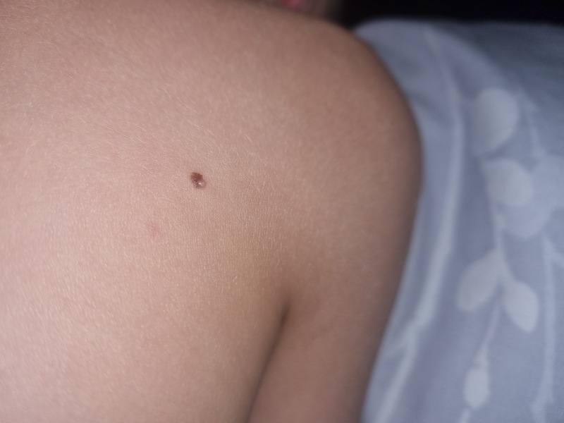 Strange looking mole on sons back!