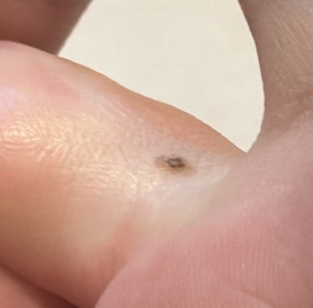Abnormal moles?