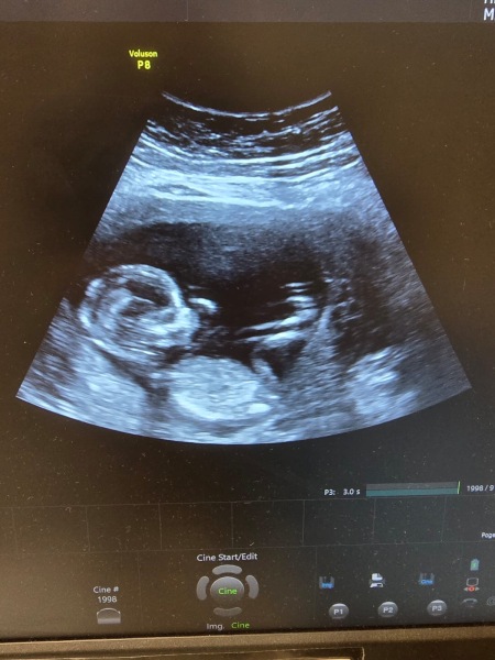 Boy or girl? Nub and skull theory?
