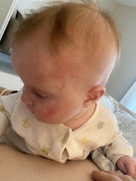 Help! Skin rashes on 4.5 month old!