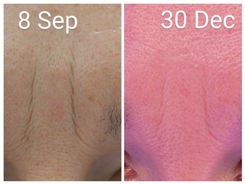 Tretinoin 0.006 - I think I can see an improvement already!! (Pic)
