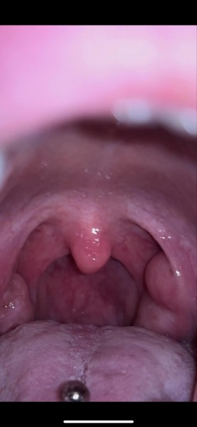 Tonsils