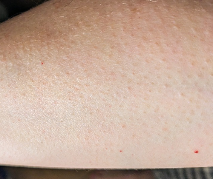 Is this petechiae?