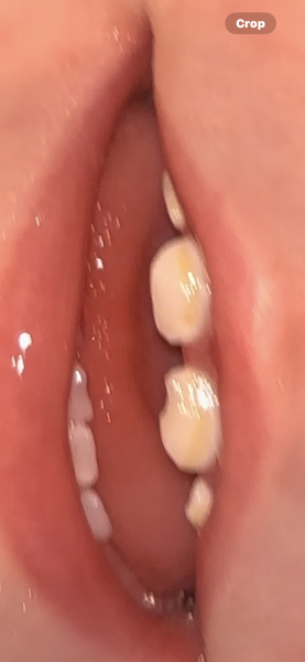 11MO brushing teeth- why is it so hard?