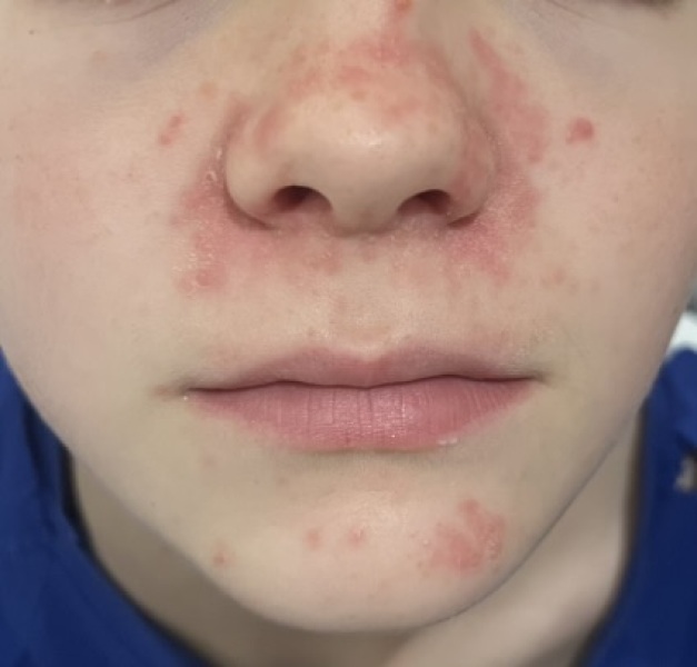 Eczema, acne, something else???