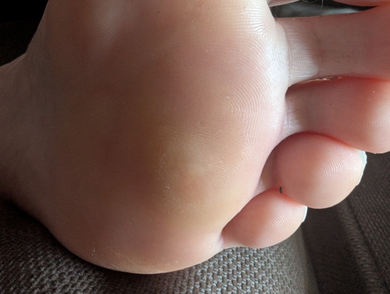 Is this a corn? Sorry pic! So sore!
