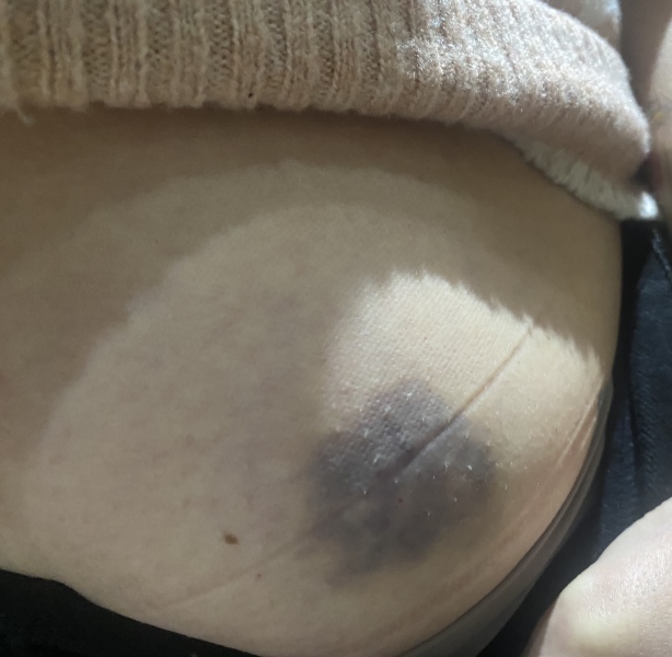 Bruise at injection site