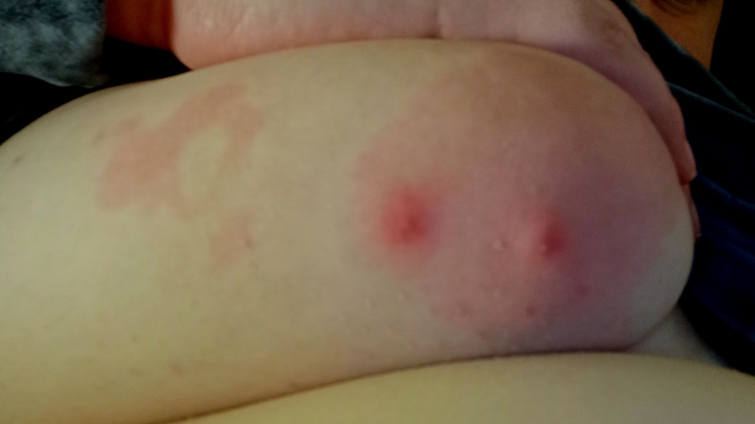 Problem under breast -GP?