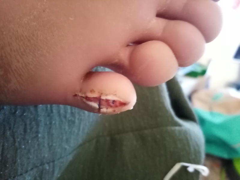 Melanoma on little toe? Picture attached.