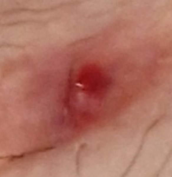 Large red spot on old c section scar