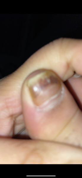 My toenails have weird black lines on them