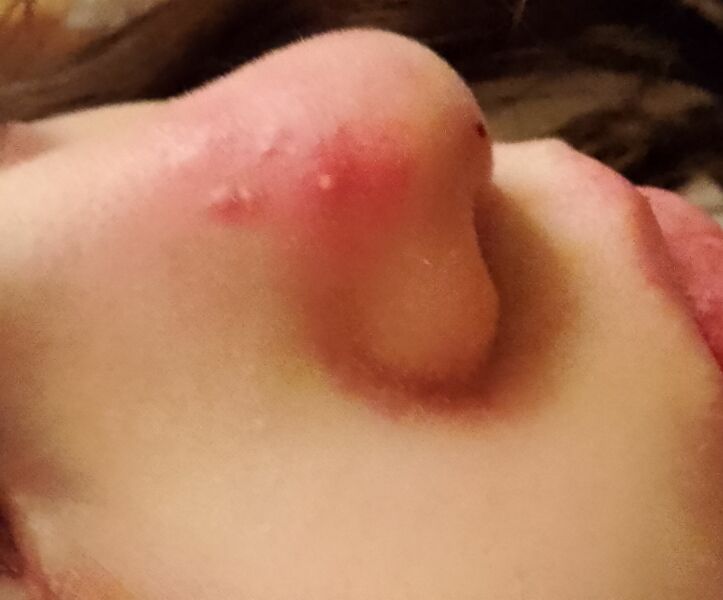 Child's skin infection on face and no one cares