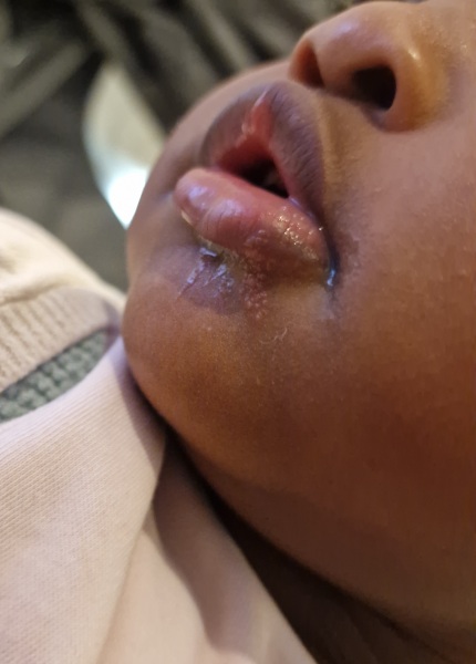 13 month old has cold sore should I be worried?