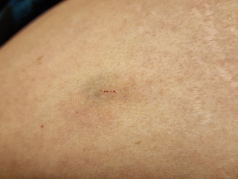 My bruised stomach (photo)