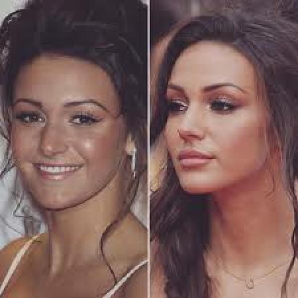 Why do people get massive amounts of lip filler?
