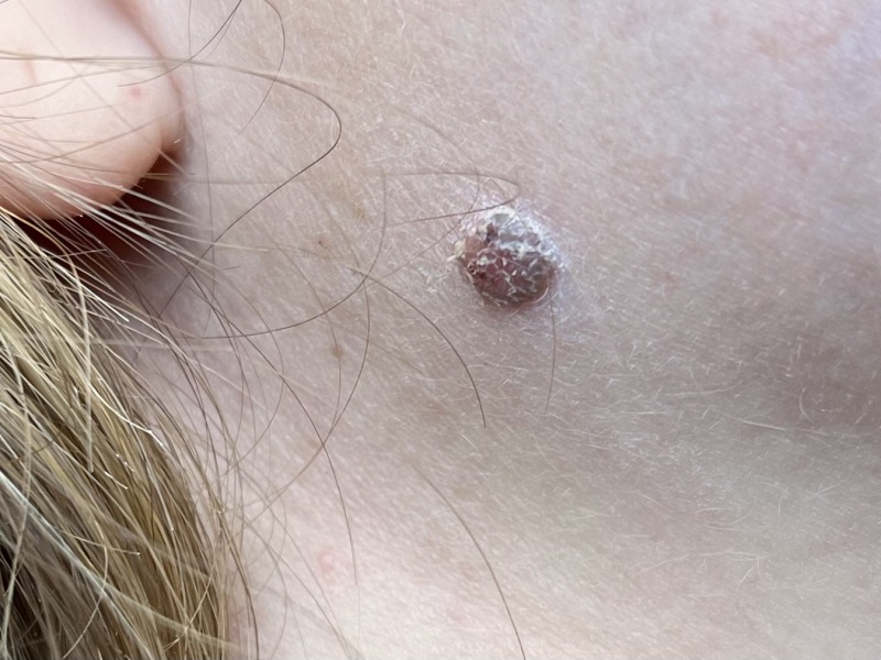 Concerned this might be nodular melanoma