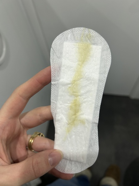 Discharge concern (picture warning)