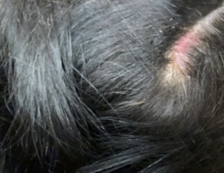Open sores on scalp