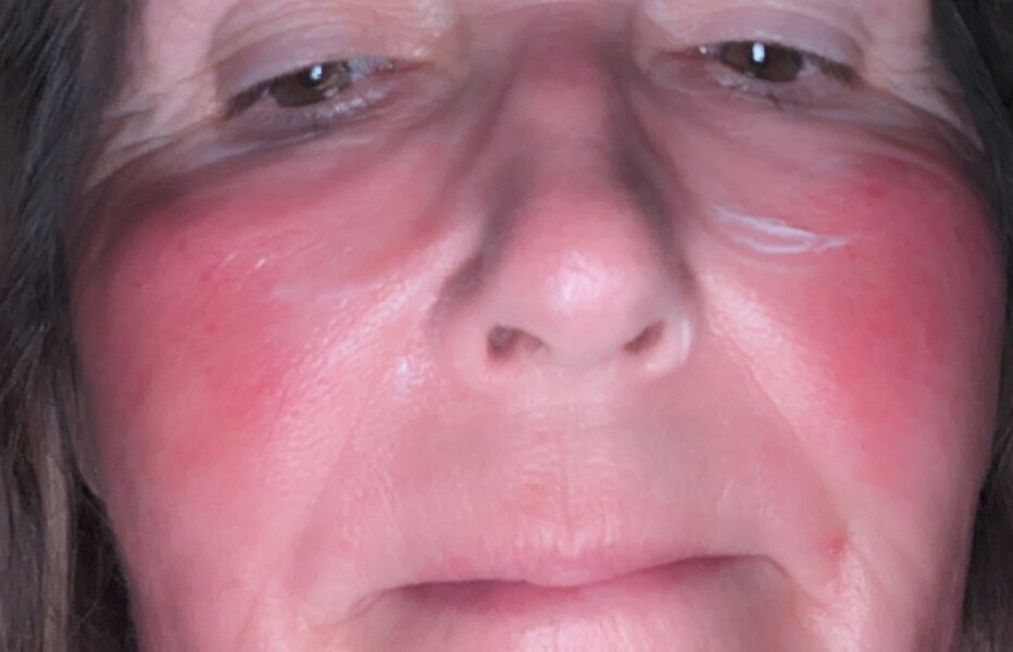 Rosacea. What works and what doesn't.