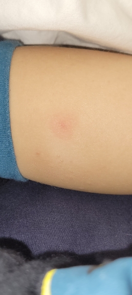 Does this look like molloscum?